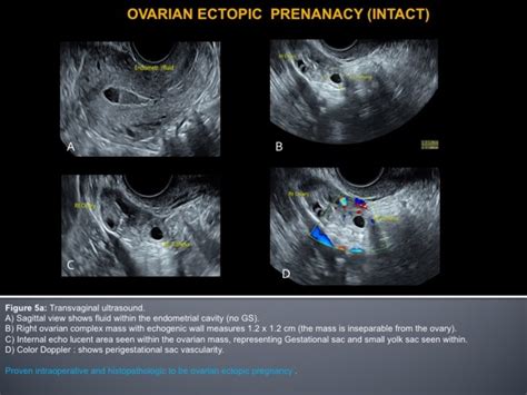 Ovarian Ectopic Prenanacy Intact Download Scientific Diagram
