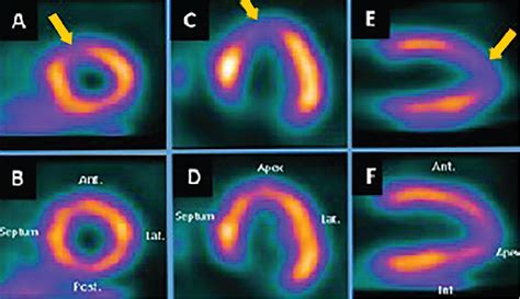 Stress Testing And Noninvasive Coronary Imaging Whats The Best Test