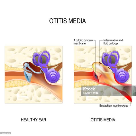 Otitis Media Human Anatomy Stock Illustration Download Image Now