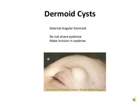 Epidermoid Cyst Vs Sebaceous Cyst What To Expect From A Cyst Removal