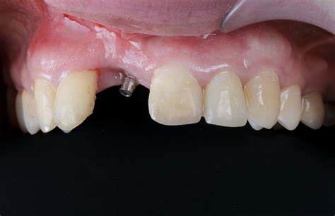 Risk Factors Of Dental Implant Failure Dental Implants Chula Vista