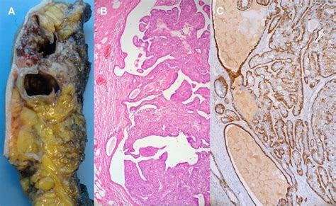 Intraductal Papilloma On Gross Examination The Papillary Lesion Grows