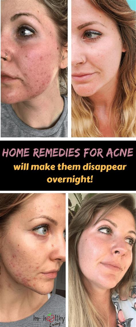 These Home Remedies For Acne Will Make Them Disappear Overnight Home Remedies For Acne Acne