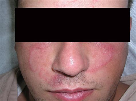 Superficial Fungal Infections Tinea Faciale Picture Hellenic
