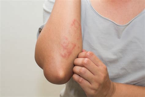 Common Skin Rashes And What To Do About Them 2022
