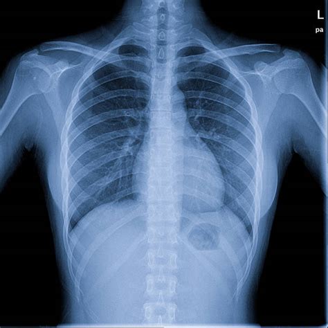 Female Chest X Ray Stock Photos Pictures And Royalty Free Images Istock