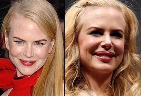 Nicole Kidman Before And After Plastic Surgery Facelift Botox Lip