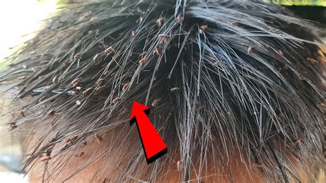 Extreme Head Lice Removal Big Lice Combing Youtube