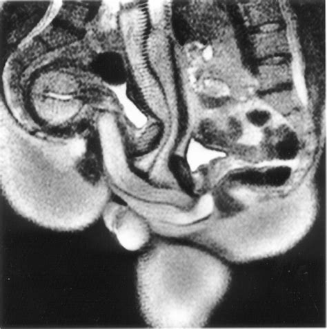 MRI Image Of The Anatomy Of Hetero Sexual Intercourse Download Scientific Diagram