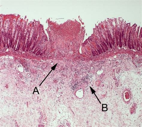 Histological Image Taken From The Resected Colon He × Open I