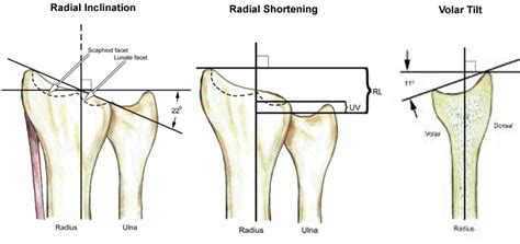 Distal Radius Fractures Trauma Orthobullets