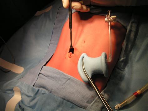 Early Experience With Single Incision Laparoscopic Surgery For The