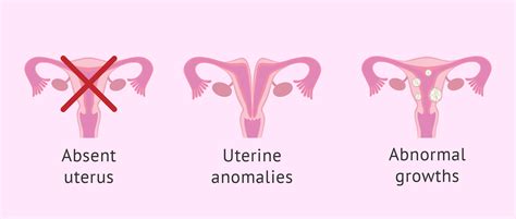 Uterine Diseases And Anomalies
