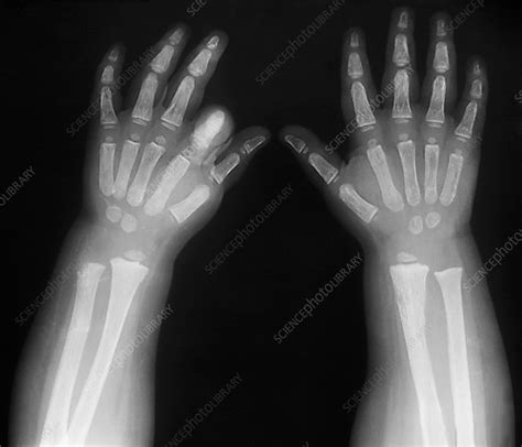 Check spelling or type a new query. Hypothyroidism, X-ray - Stock Image - M170/0385 - Science Photo Library