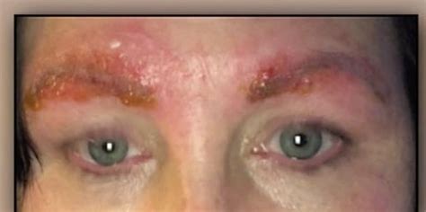 Check spelling or type a new query. Woman Hospitalized With Eyebrow Infection From Microblading