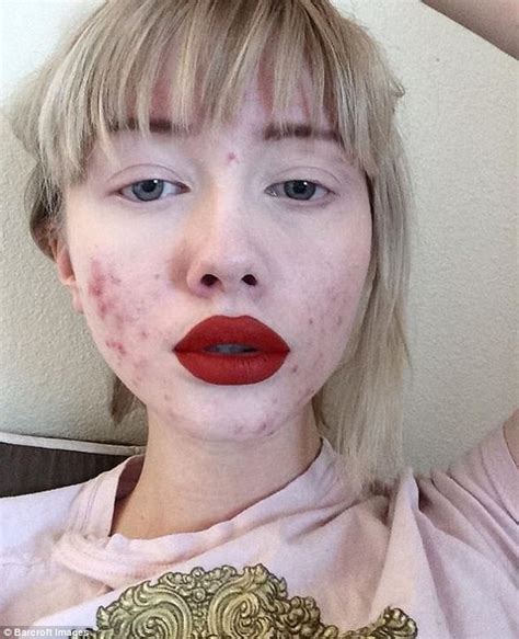 Acne Blogger Goes Makeup Free In Her Instagram Posts Daily Mail Online
