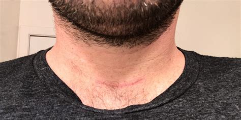 Are symptoms always a sign of thyroid cancer? My Thyroid Got Cancer | The Mighty