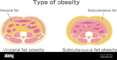 Tipo De Ilustración De Obesidad Vista Transversal Abdominal Grasa