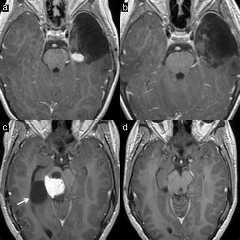 Mri Axial T1 Gadolinium In Patient 1 Pretreatment A And