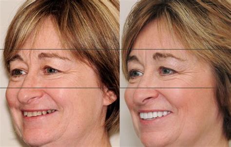 Strengthen Face Skin And Jowls Using Facial Aerobics Detest Baggy Face