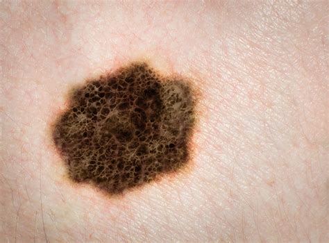 Melanoma How Do I Check Myself For Melanoma Melanoma Institute