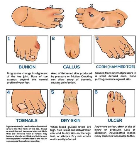 Foot And Ankle Problems Associated With Diabetes Nima Sana Dpm Podiatrist