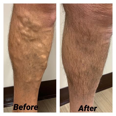 Varicose Veins The Vein And Laser Centre