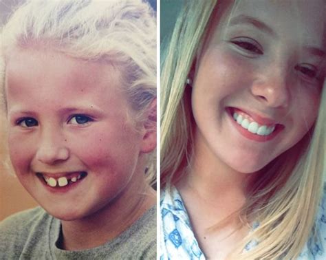 Id Like To Thank Jesus And All Those Years Of Braces For This Braces Before And After After