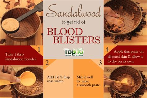 How To Get Rid Of Blood Blisters Top 10 Home Remedies