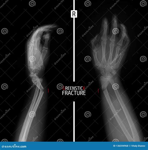 X Ray Of The Wrist Greenstick Fracture Of The Radius Marker Stock