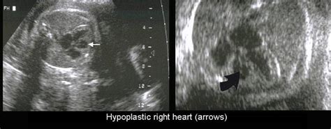 Hypoplastic Right Heart Syndrome