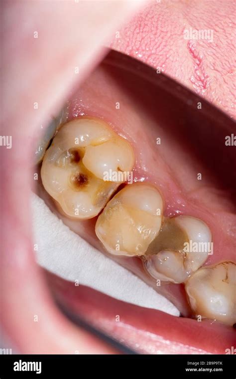 Dental Caries Filling With Dental Composite Photopolymer Material