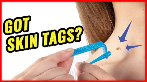 how to remove skin tags fast with tagband youtube