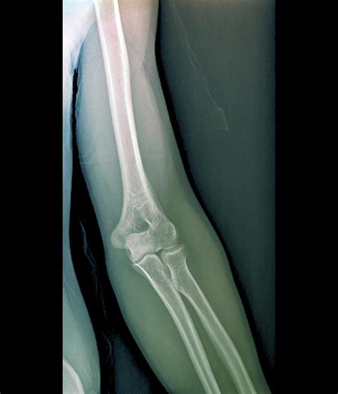 Normal Elbow Joint Photograph By Zephyrscience Photo Library