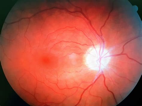 Digital Eye Exams Bridlewood Eye Care Digital Retinal Imaging In