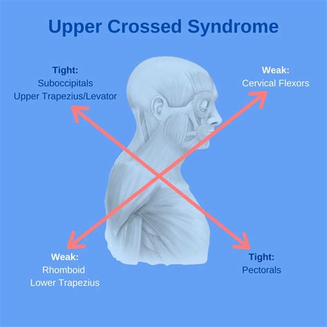 Upper Crossed Syndrome — Eglinton Physiotherapy