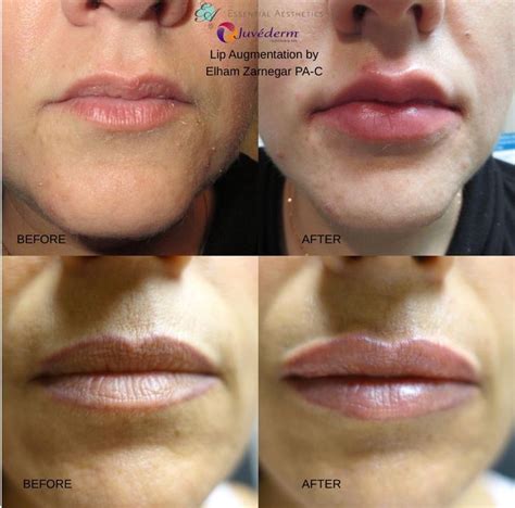 Juvederm Adds Volume To The Lips And Smooths Verticals Lip Lines