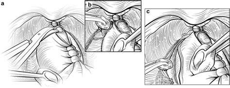 Open Radical Retropubic Prostatectomy Radiology Key