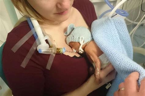 Premature Baby Born With Head The Size Of A Golf Ball