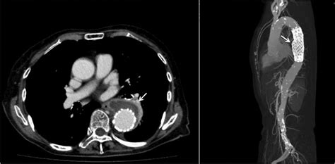 A Case Of Penetrating Atherosclerotic Ulcer Treated With Thoracic