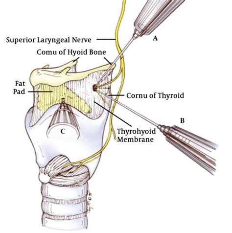 Upper Airway Nerve Block For Rigid Bronchoscopy In The Patients With