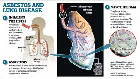 Asbestos Lung Disease Mesothelioma