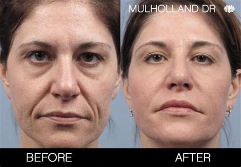 Softtissuefillers Dermalfillers Injectables Toronto Before And