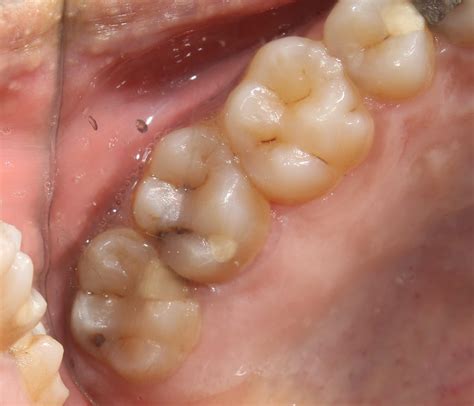 Upper Third Molar Operative Tips Myzerodonto