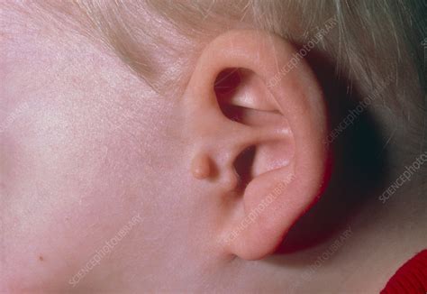 Auricular Ear Appendage A Congenital Deformity Stock Image M350