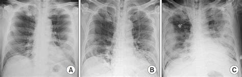 Chest Film Demonstrating Reverse Batwing Pulmonary Opacities In A