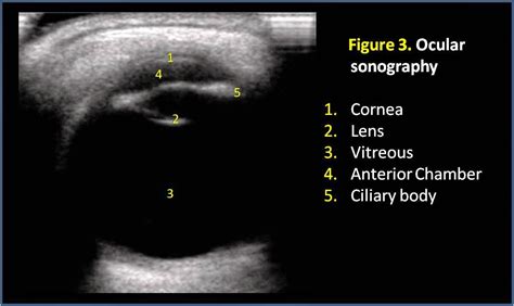 Emergency Ultrasound Post Number 6 Ocular Ultrasounds Eye Ultrasounds