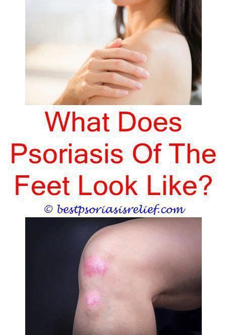 Bestfacecream Plaque Psoriasis Treatment Psoriasis Treatment Cream
