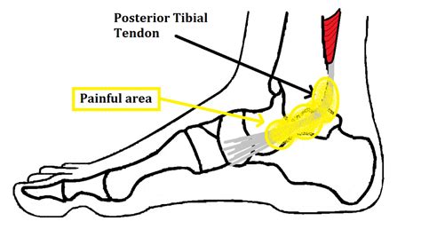 Posterior Tibial Tendon Dysfunction Experts In Ankle Pain