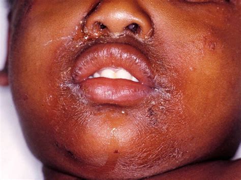 Staphylococcal Scalded Skin Syndrome Ssss